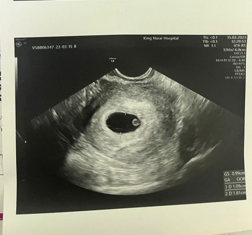 ท้อง6W ปวดท้องหน่วงตลอด