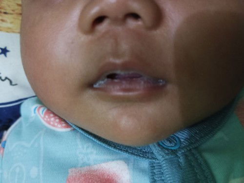bibir bayi putih