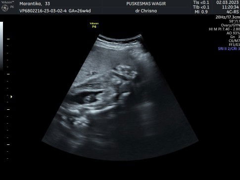 Hasil usg ada yg bisa baca atau sama mungkin ya?