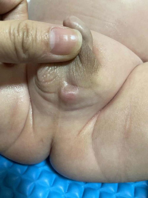 Bukol sa baba ng testis ni baby