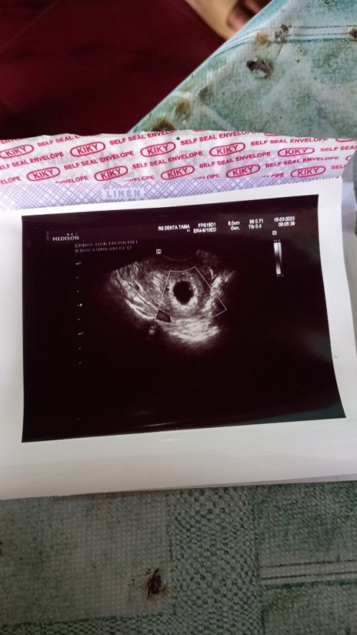 Hamil 7 w,kmrin usg transvaginal bru kantong aja blm ada isinya apa2 ,kira2 msh norml engg y bund,
