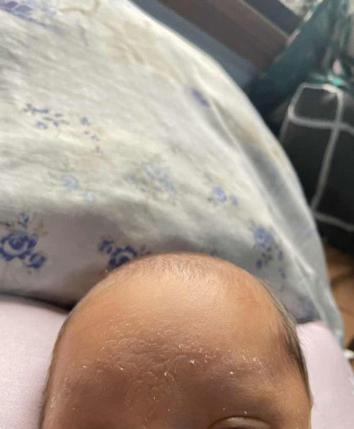 Cradle Cap or Dry Skin sa Forehead
