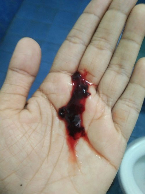 ภาวะแท้งคุกคาม