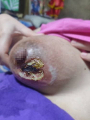 Help po nagkaroon po ako ng mastitis,pumutok na po sya at madaming nana ang lumabas,Advice po ty🙏