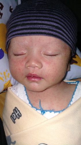 Bunda2 mau bertanya anak aku usia 2 minggu , seluruh badannya ada bintik warna merah kira2 solusiny