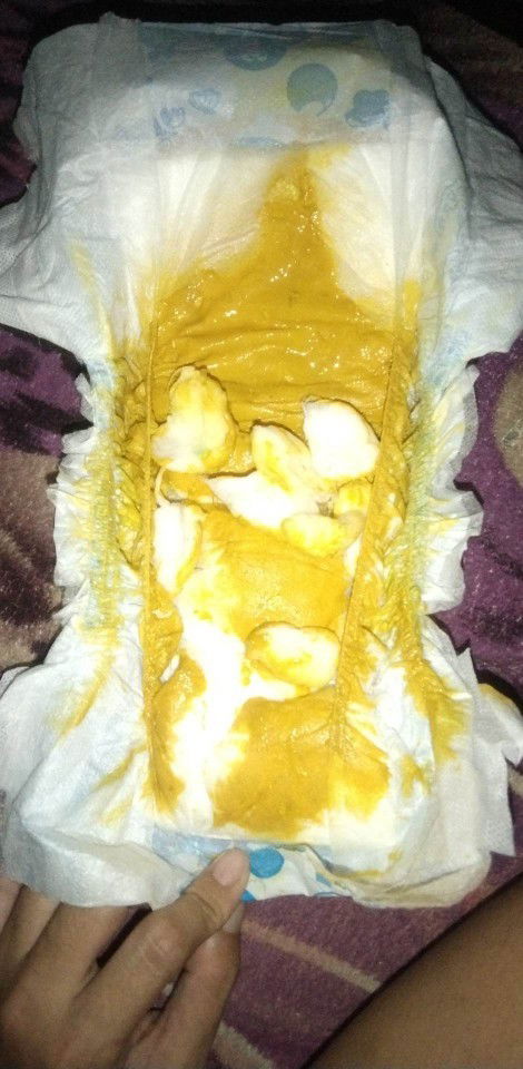 Diarrhea (watery yellow poop)