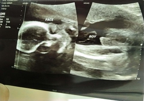 Baby gender