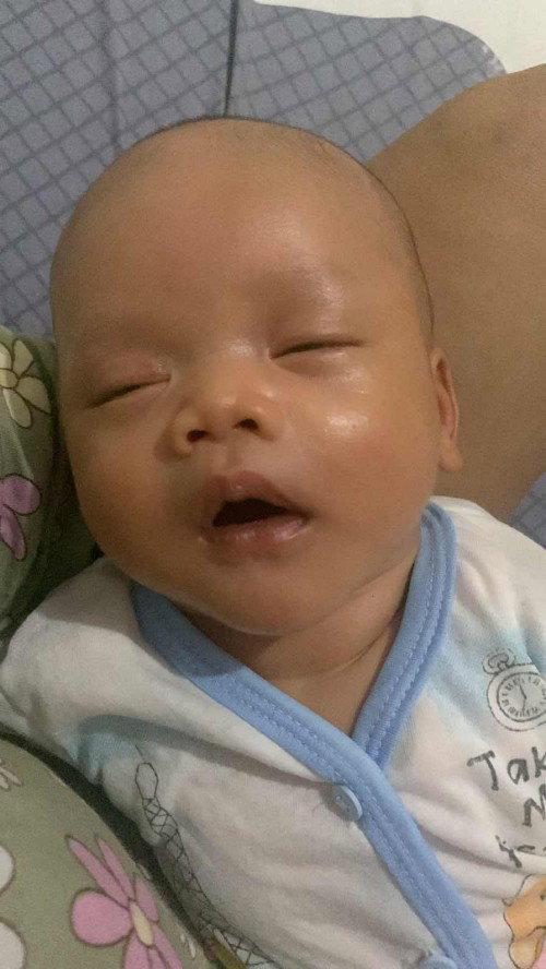 Bayi kuning usia 1 bulan 8 hari