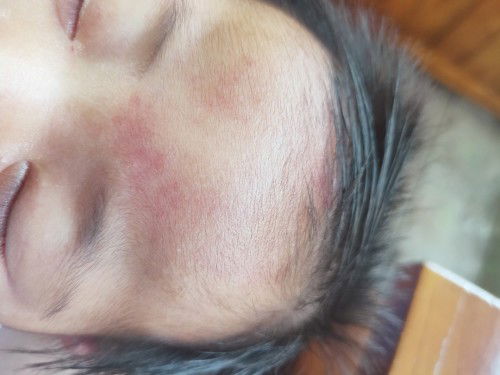 Merah pada wajah bayi