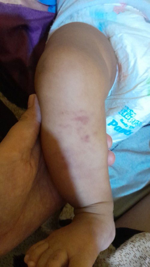 Kaki bayi memar / gatal ?