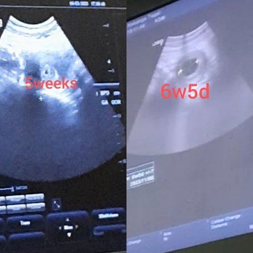 HAMIL 6W5D BELUM TERLIHAT JANIN