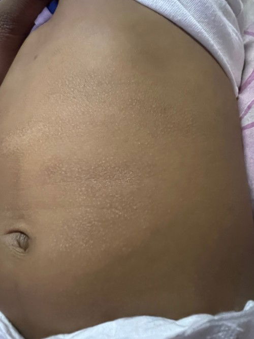 my 3 months baby got skin like at tummy. Don't know why suddenly like this.