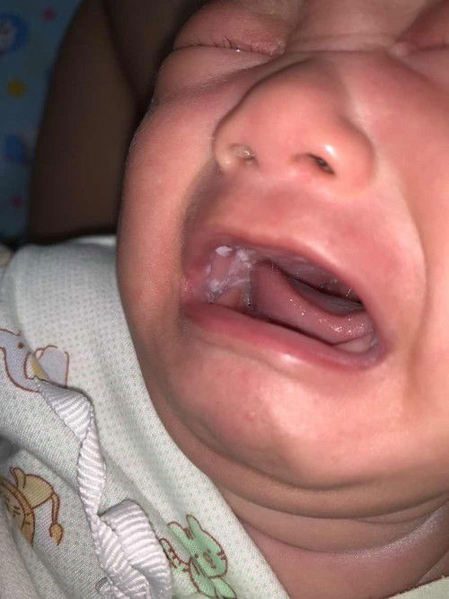 ลูกเป็นฝ้าขาวที่กระพุ้งแก้ม