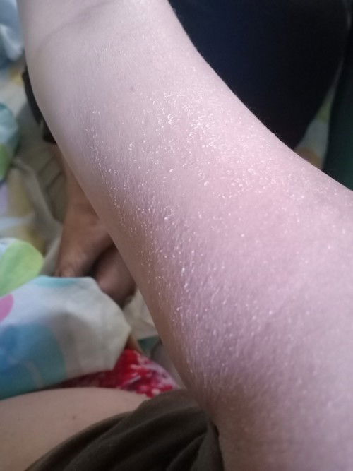 Pamamalat ( Skin itching )