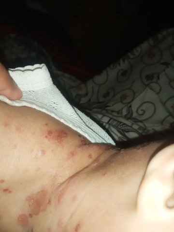 Impetigo pada anak 1tahun 4buln