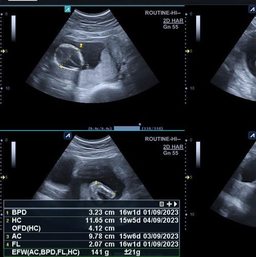 BB janin usia 16 week