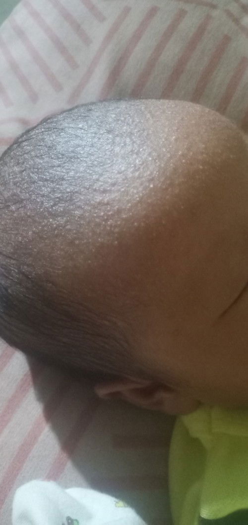 obat buat bruntusan baby new born