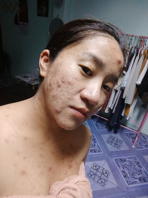 เรื่องสิวๆ ที่ไม่จิ๋วเลย 😭