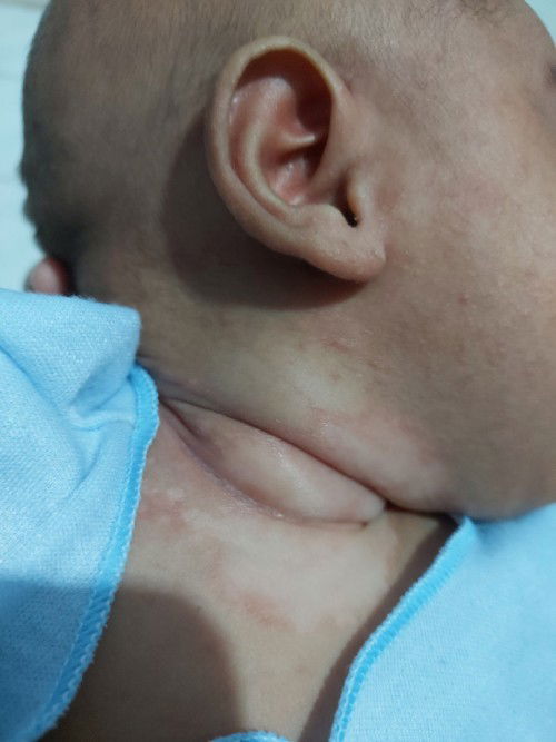 Leher bayi ruam merah