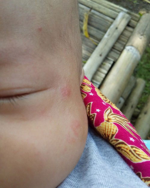 Merah pada muka bayi