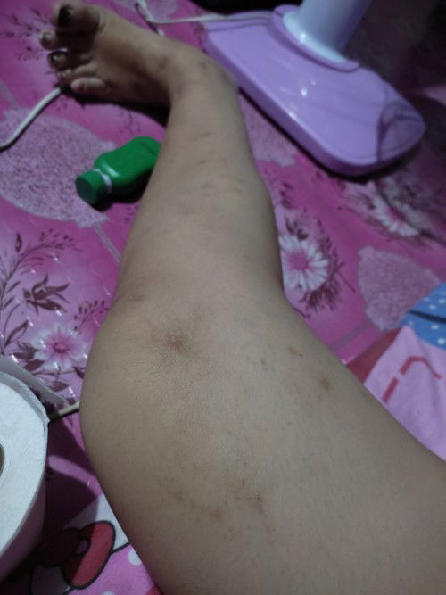 Mga mii ask ko lang kung anung mgandang lotion na pwde sa preggy para maglighten yng mga peklat ko