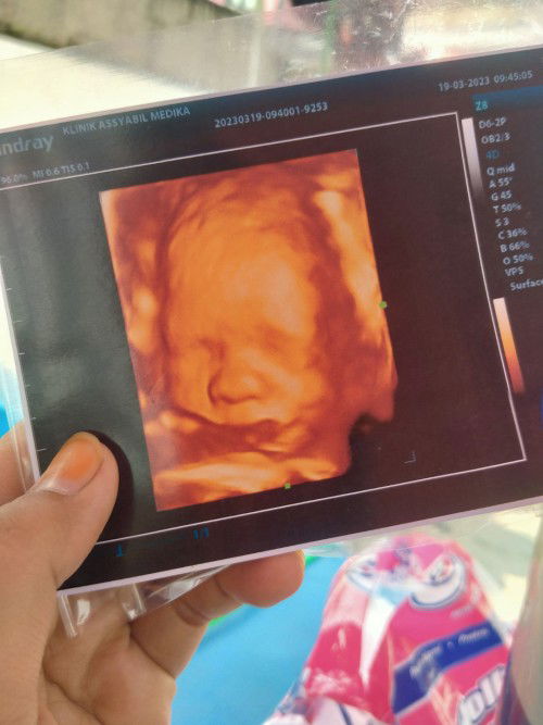 Mw 30week BB 1399gr ,posisi Mash belum muter , efek kecapean plasenta aga turun nih Bun