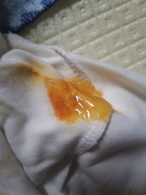 feses bayi 4bulan ada bercak darah