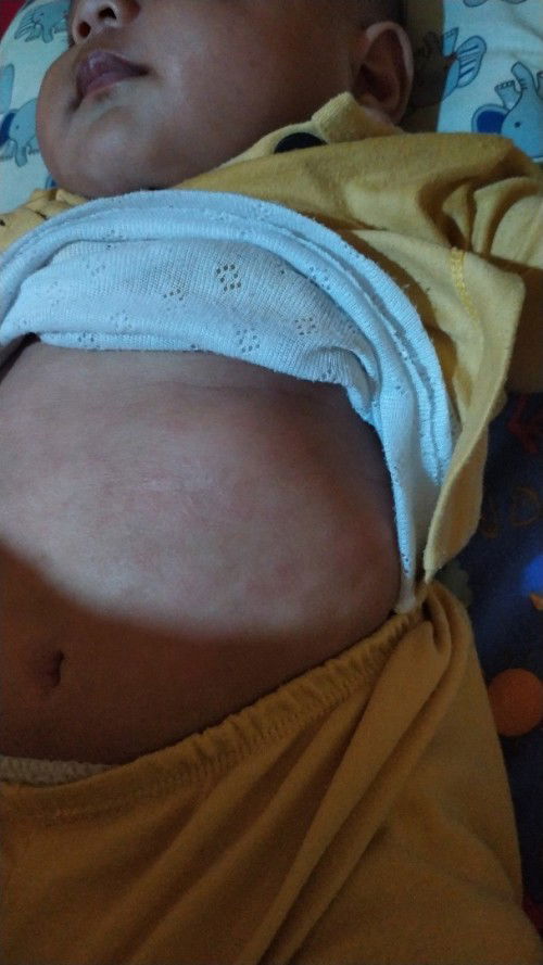 Tulang rusuk menonjol sebelah