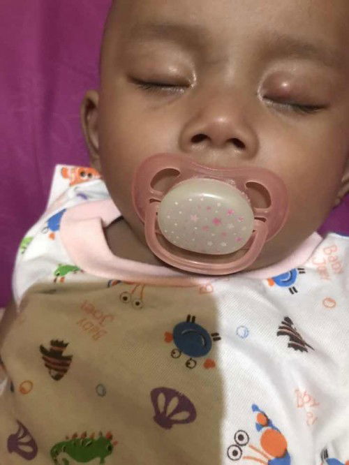 bundaa,ada yg pernah bayi nya kayak ada benjolan di kelopak mata,,udah 1 minggu lebih