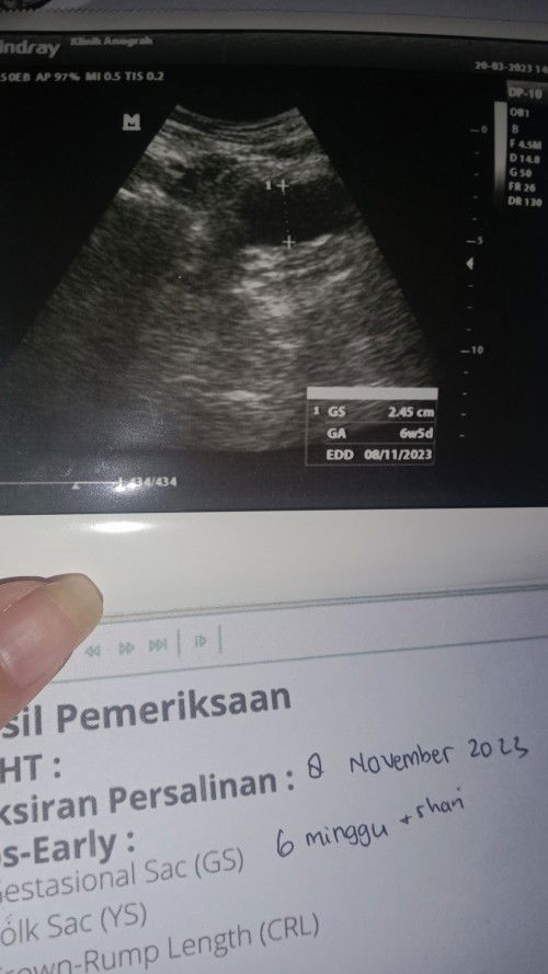 Normal kah USG 6w baru terlihat kantung kehamilan aja ?