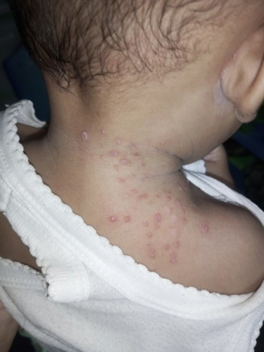 Bedak/salep apa ya mom untuk bayi bruntusan d pundak bayi 6bulan ?