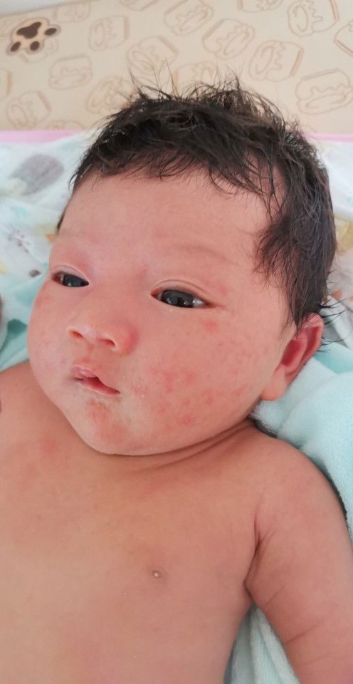 ลูกเป็นผื่นที่หน้า