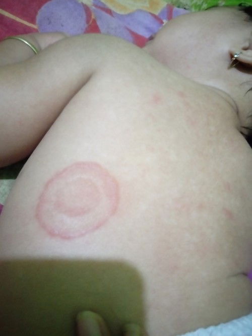 Bun mau nanya, ini kenapa ya anakku tiba² kulitnya kaya gini.. udah coba ke dokter dikasih salep