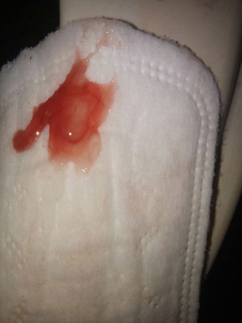 jelly discharge with blood