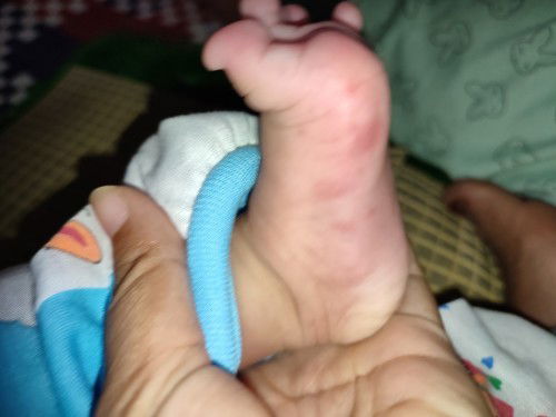 Bintik merah di telapak kaki dan tangan