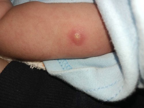 Muncul benjolan merah kecil di lengan bayi baru lahir