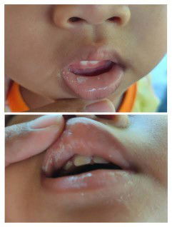 Jamur di mulut anak 1 tahun