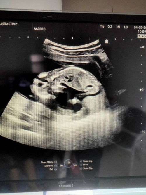 โชว์รูปอัลตร้าซาวด์ลูกกันค่ะ