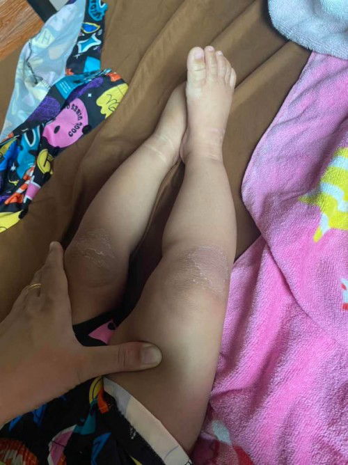 ลูกเท้าเหี่ยวลอก