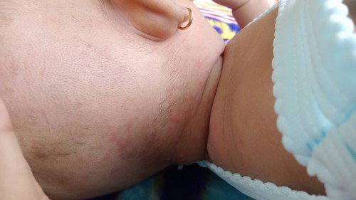 Gatal pada bayi