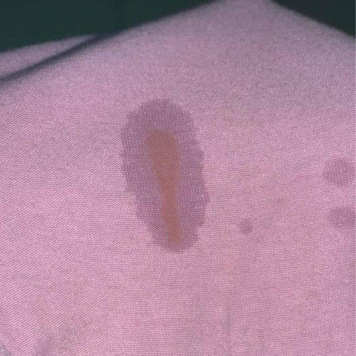 Keluar Cecair Coklat selepas menjalani ujian keputihan pada Trimester ke-3