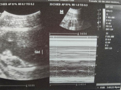 PWEDE PA BANG MABAGO ANG GENDER NI BABY?