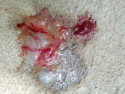 อยากถามแม่แม่ว่าใครเคยมีเสมหะออกเป็นเลือดบ้างเกิดจากอะไร