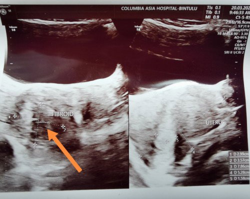 Lewat period Tapi scan ada Fibroid