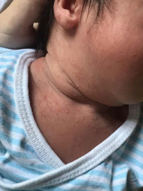 น้องเป็นผดเต็มเลย