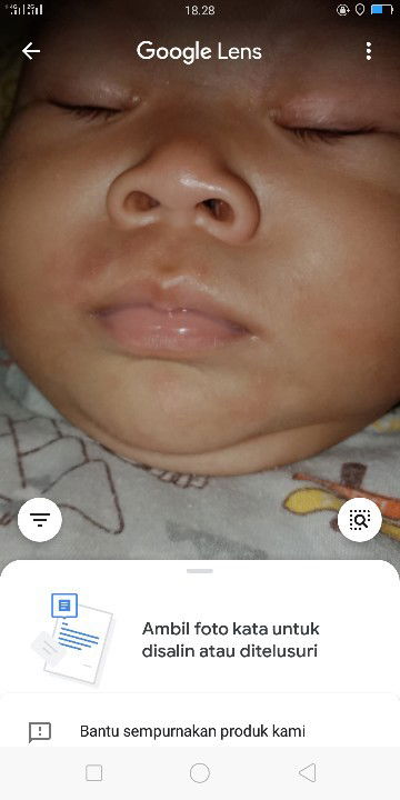 Bun ada gk yg sma kyk gni abs mkan sekitaran pipi,pinggir mulut,dagu merah seperti di gigit nyamuk