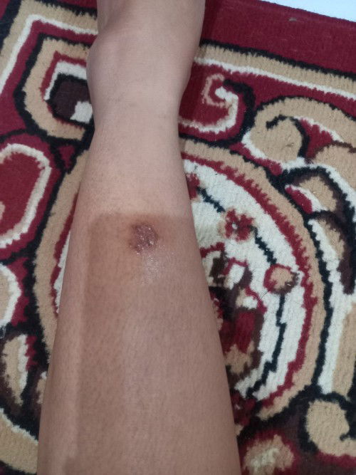 Gatal kehamilan dan pasca melahirkan