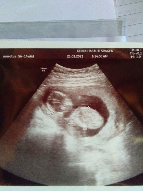 Alhamdulillah hasil USG baik 
14w2d