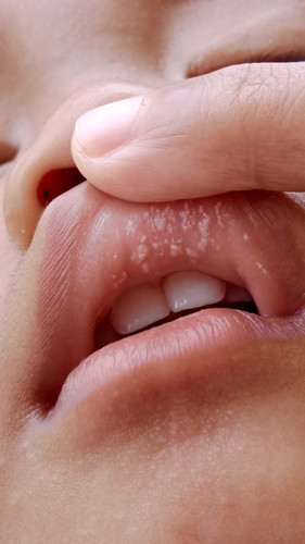Bercak putih di bibir