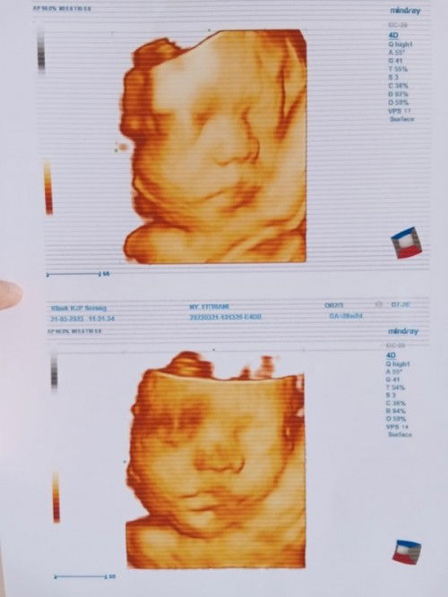 USG 4D UK janin 28 weeks